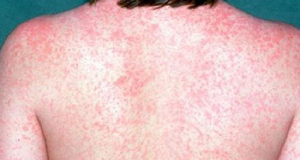 Measles now on Vancouver Island: 2 cases confirmed measles