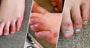 COVID-related Multisystem Inflammatory Syndrome in Children possibly in BC, says PHO COVID toes