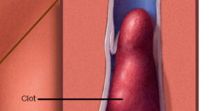 First case of blood clot in BC after AstraZeneca vaccination blood clot, Mayo Clinic