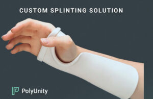 BC announces 3D-printed splints starting at Vancouver General Hospital PolyUnity, 3d splints
